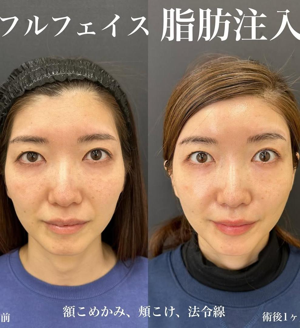 脂肪注入の症例写真