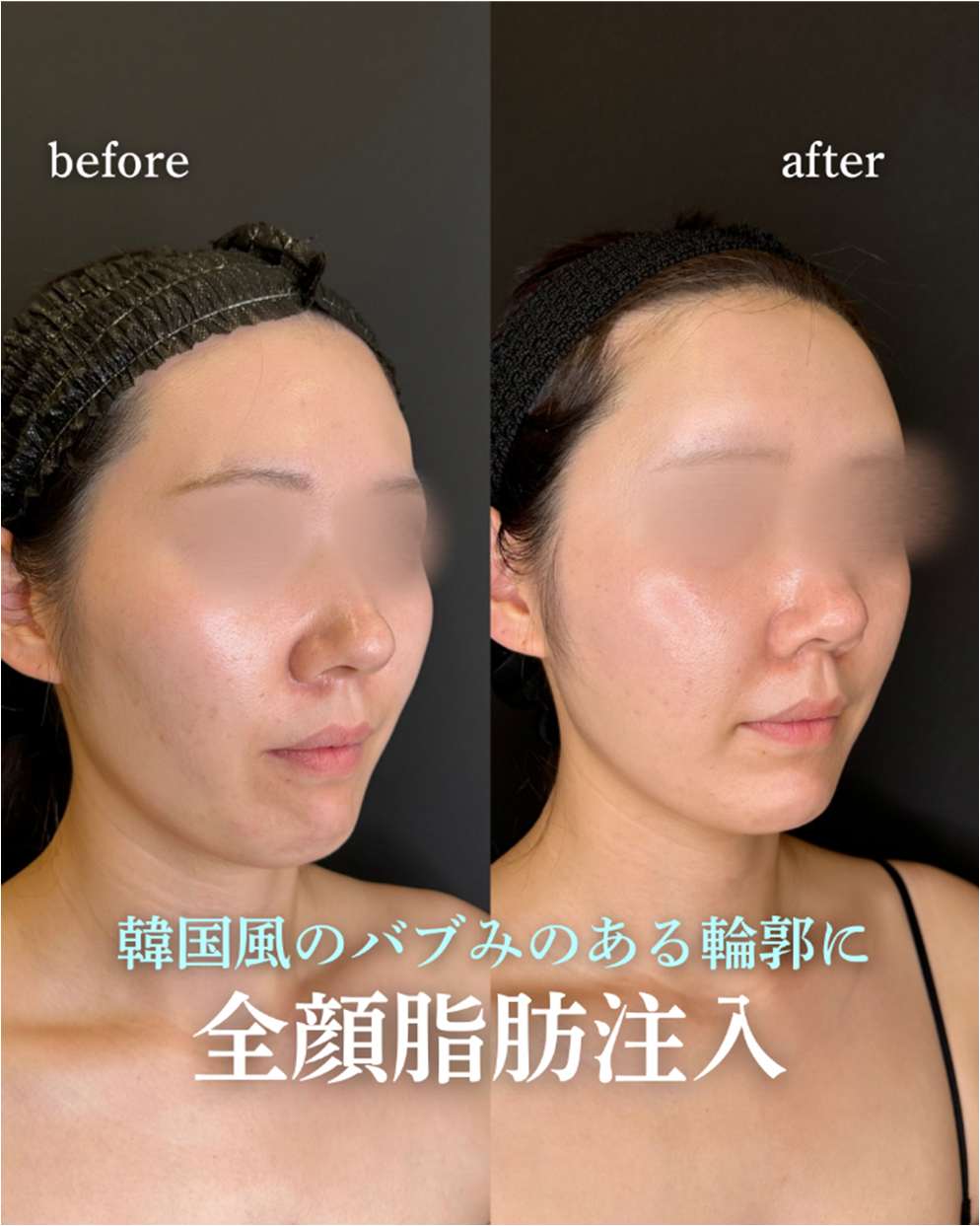 脂肪注入の症例写真