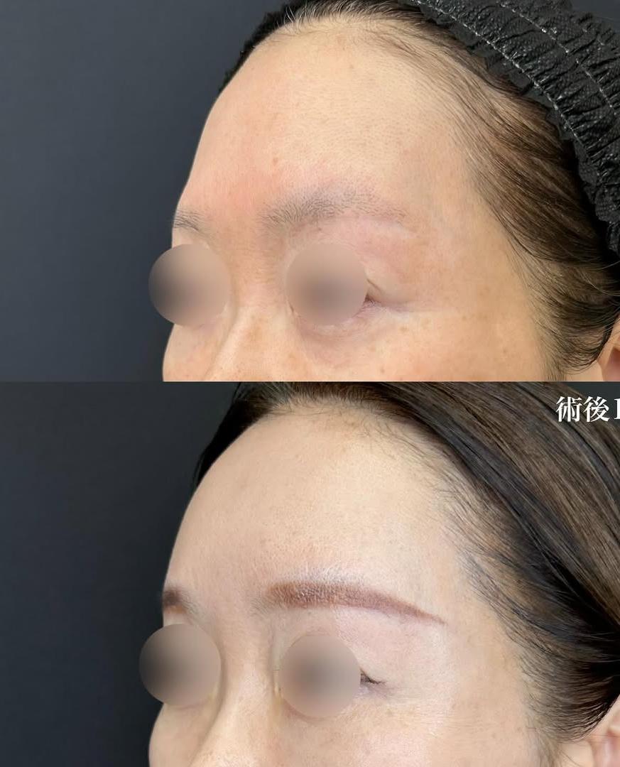 脂肪注入の症例写真