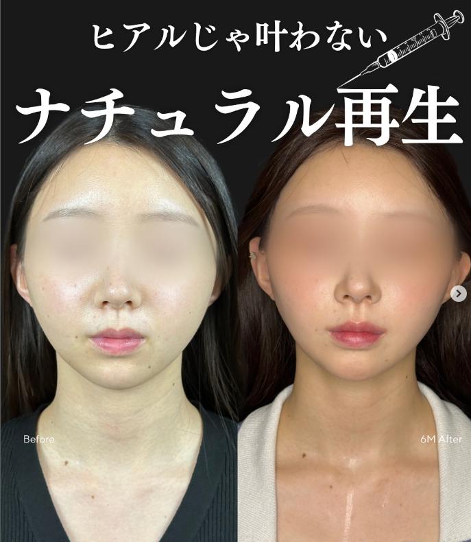 脂肪注入の症例写真