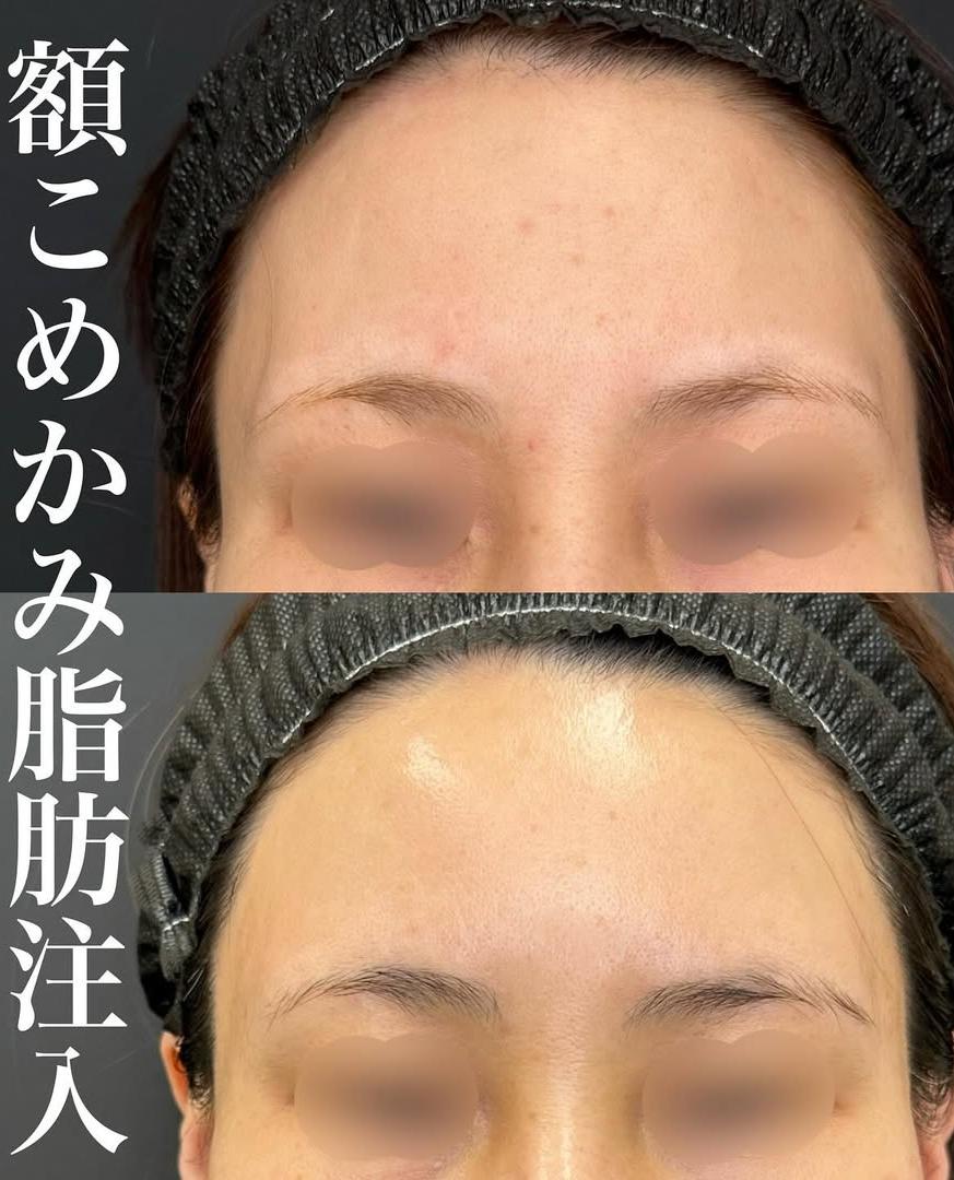 脂肪注入の症例写真