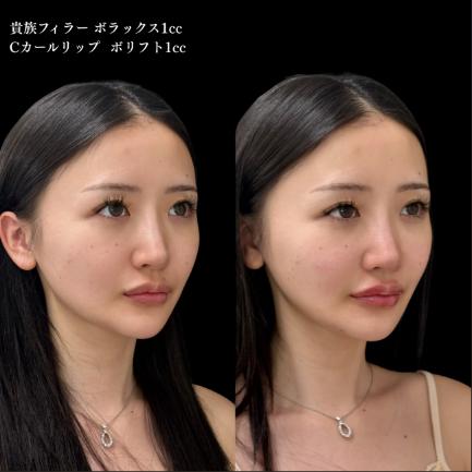 ヒアルロン酸の症例写真