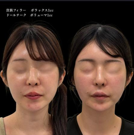 ヒアルロン酸の症例写真