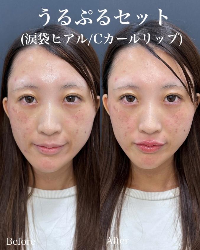 ヒアルロン酸の症例写真