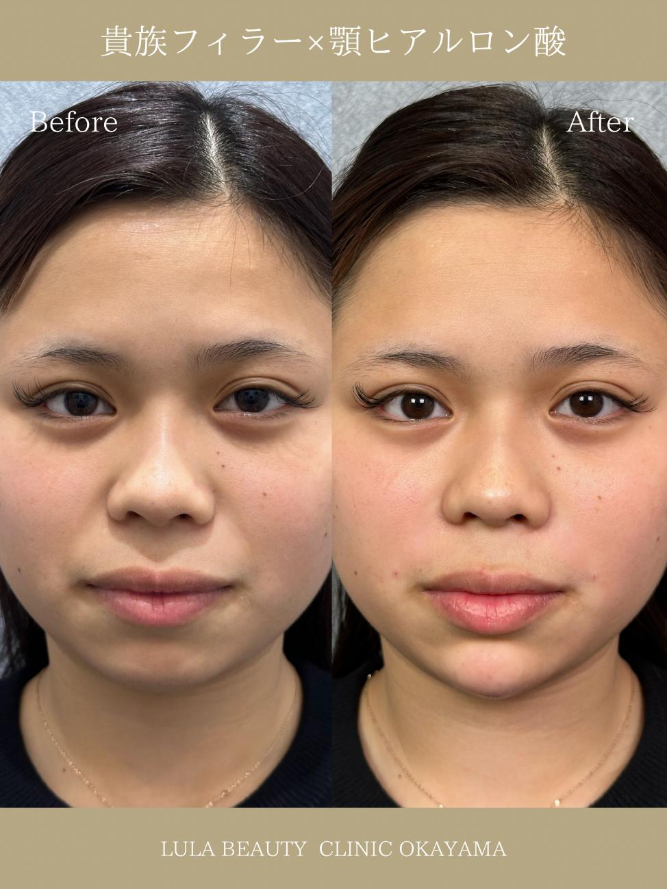 ヒアルロン酸の症例写真