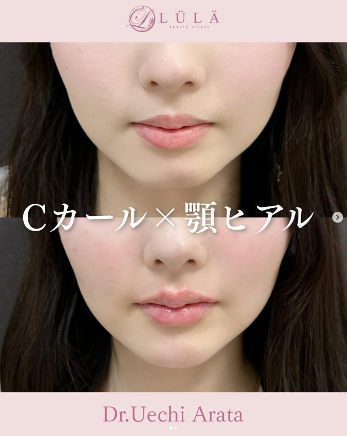 ヒアルロン酸の症例写真