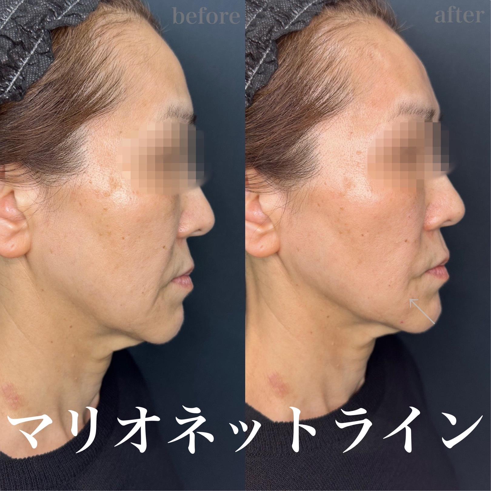 ヒアルロン酸の症例写真