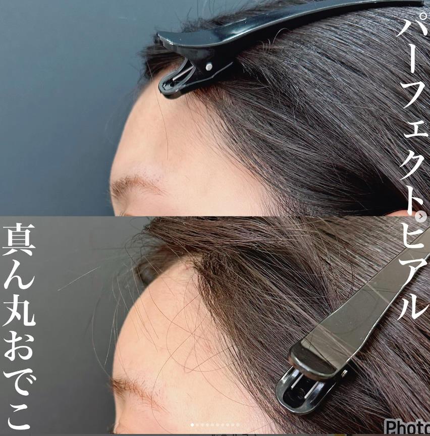 ヒアルロン酸の症例写真