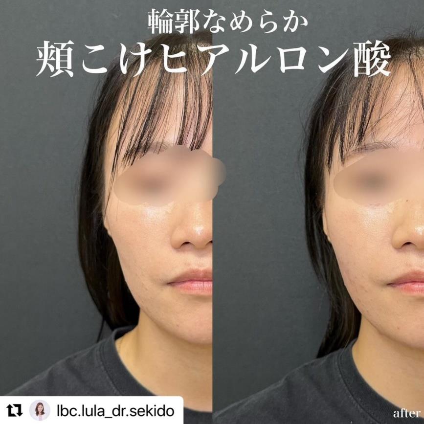 ヒアルロン酸の症例写真