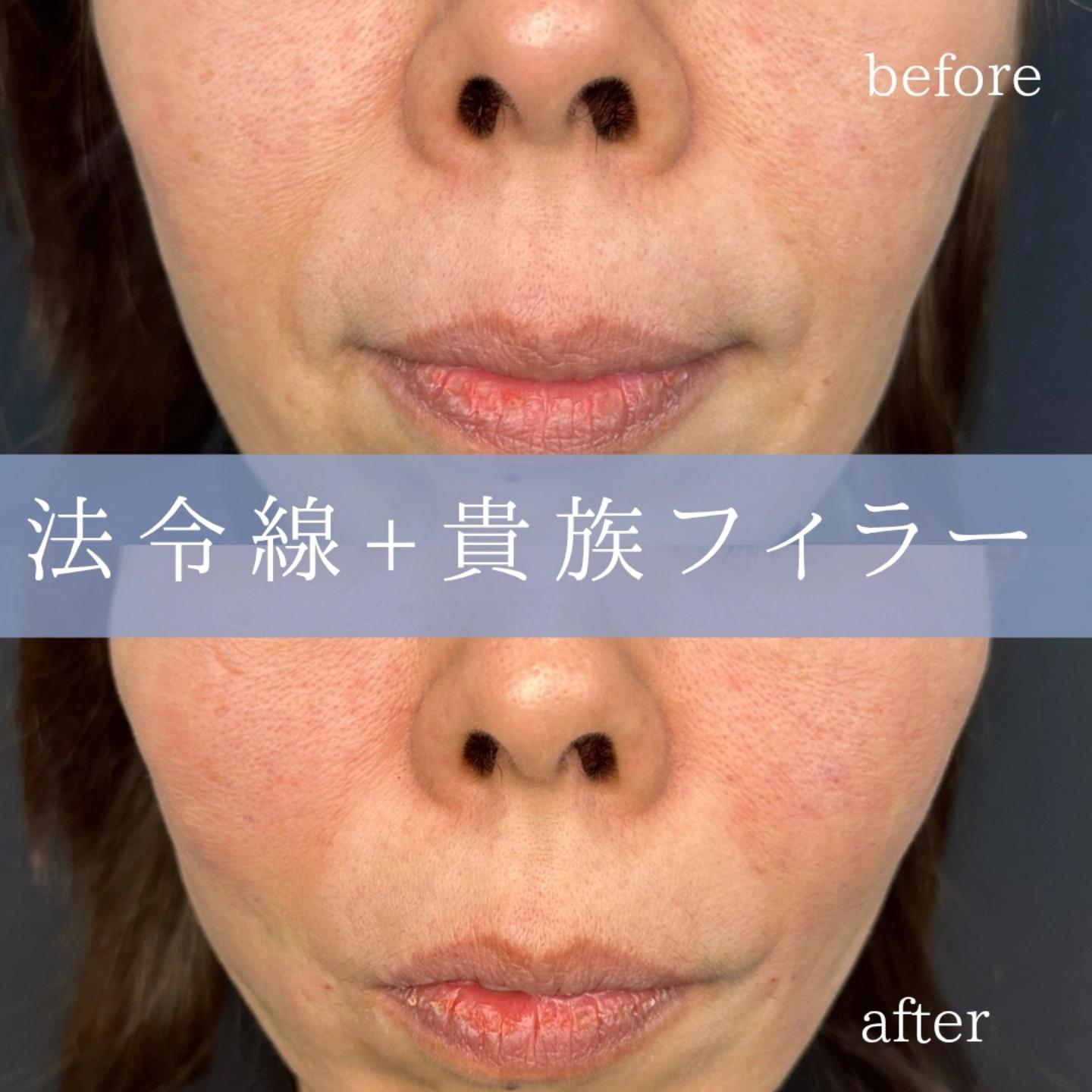 ヒアルロン酸の症例写真