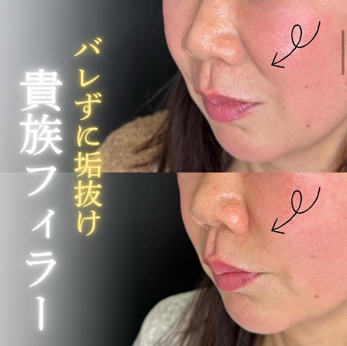 ヒアルロン酸の症例写真