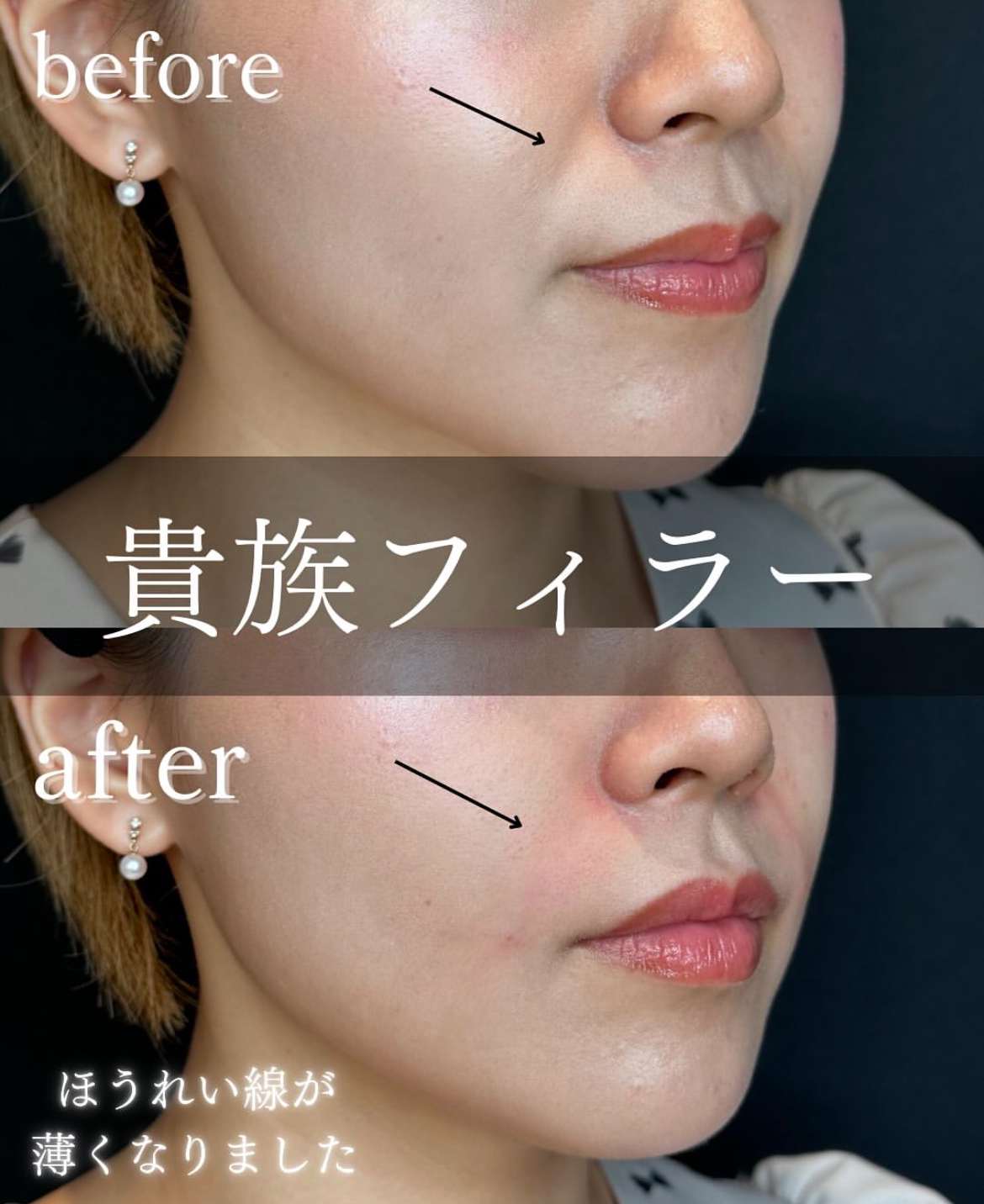 ヒアルロン酸の症例写真