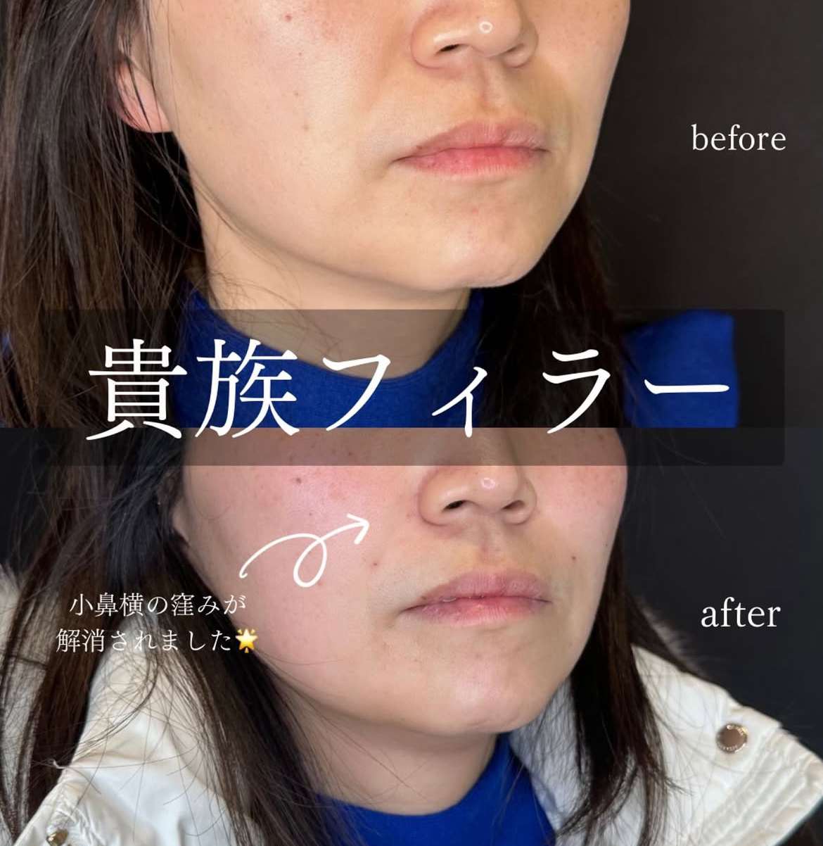 ヒアルロン酸の症例写真