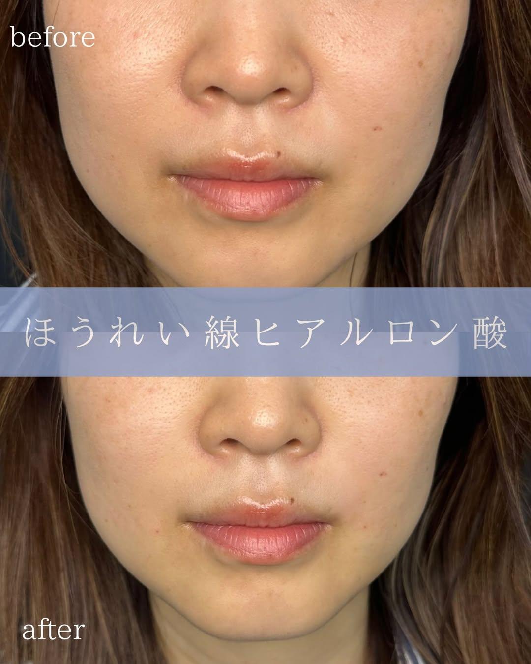 ヒアルロン酸の症例写真