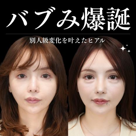 ヒアルロン酸の症例写真