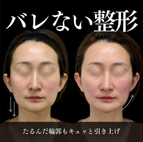 ヒアルロン酸の症例写真