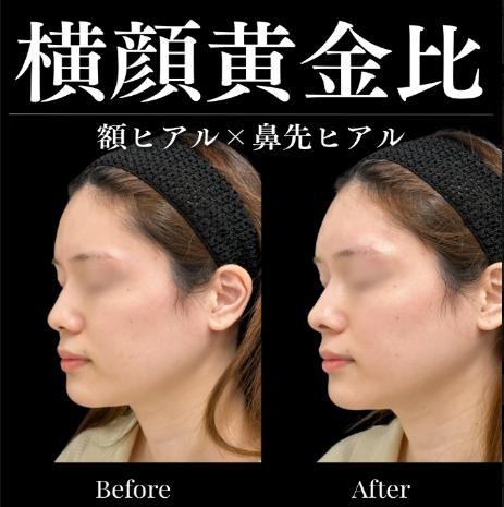 ヒアルロン酸の症例写真