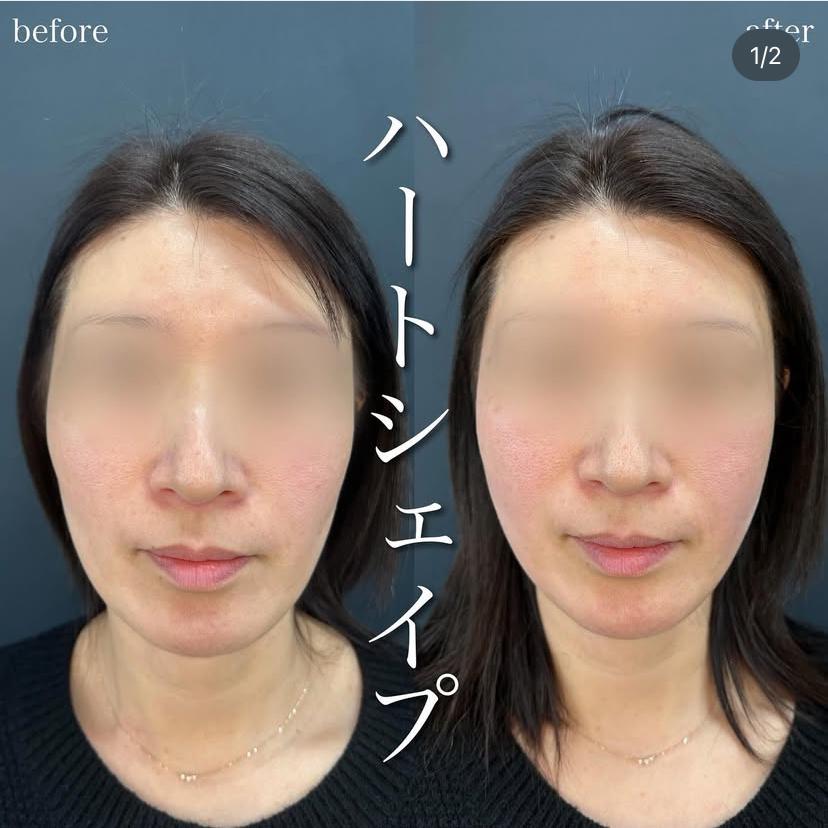 ヒアルロン酸の症例写真