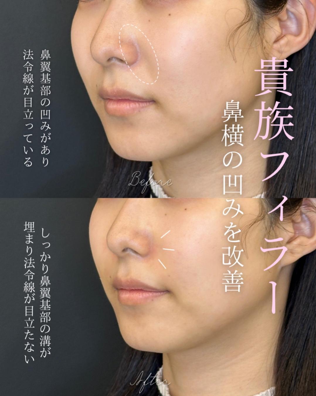 ヒアルロン酸の症例写真
