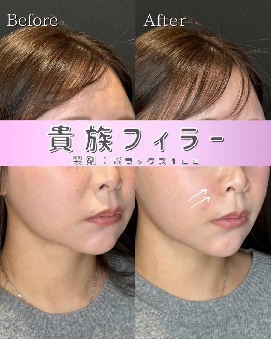 ヒアルロン酸の症例写真