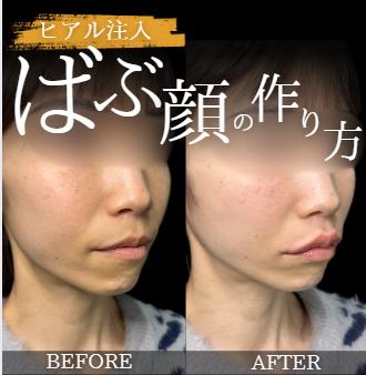 ヒアルロン酸の症例写真