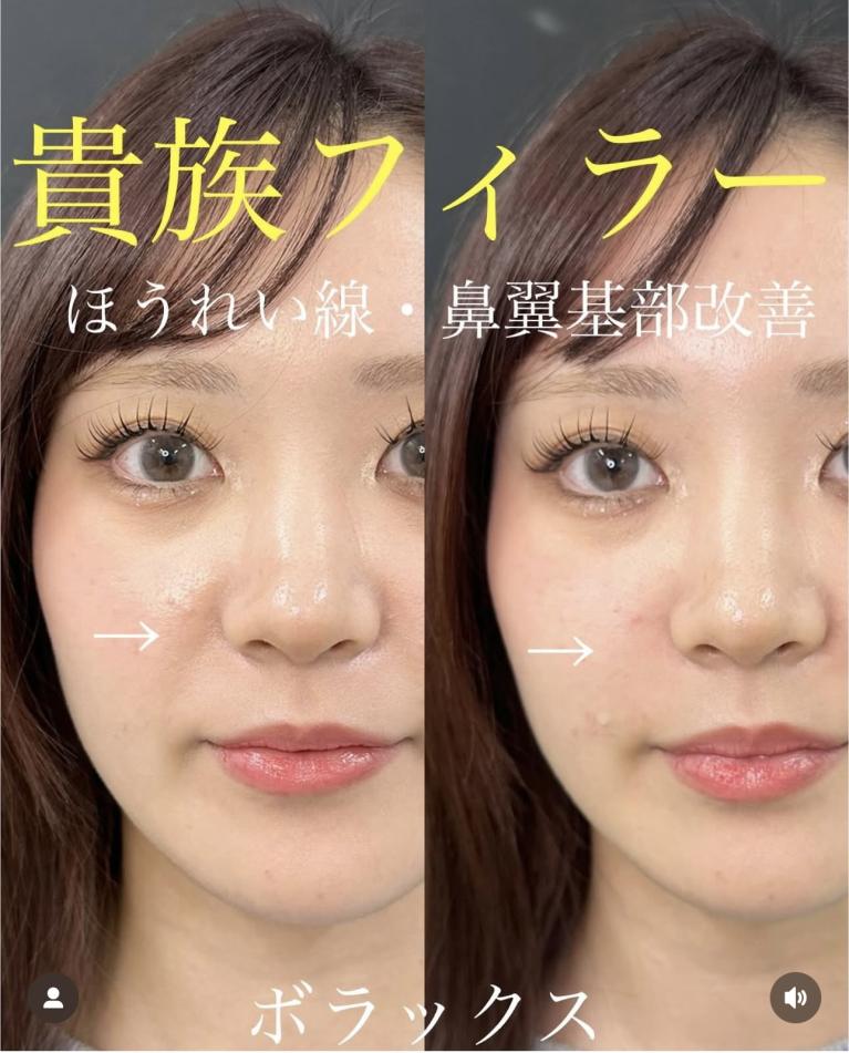 ヒアルロン酸の症例写真