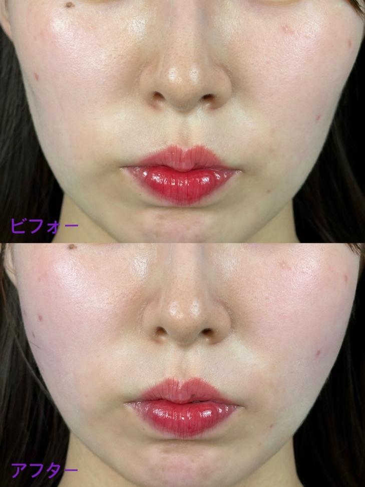 ヒアルロン酸の症例写真