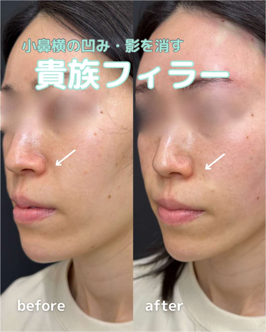 ヒアルロン酸の症例写真