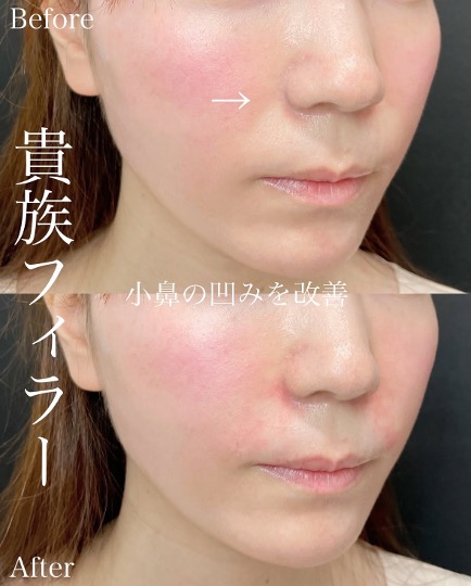 ヒアルロン酸の症例写真