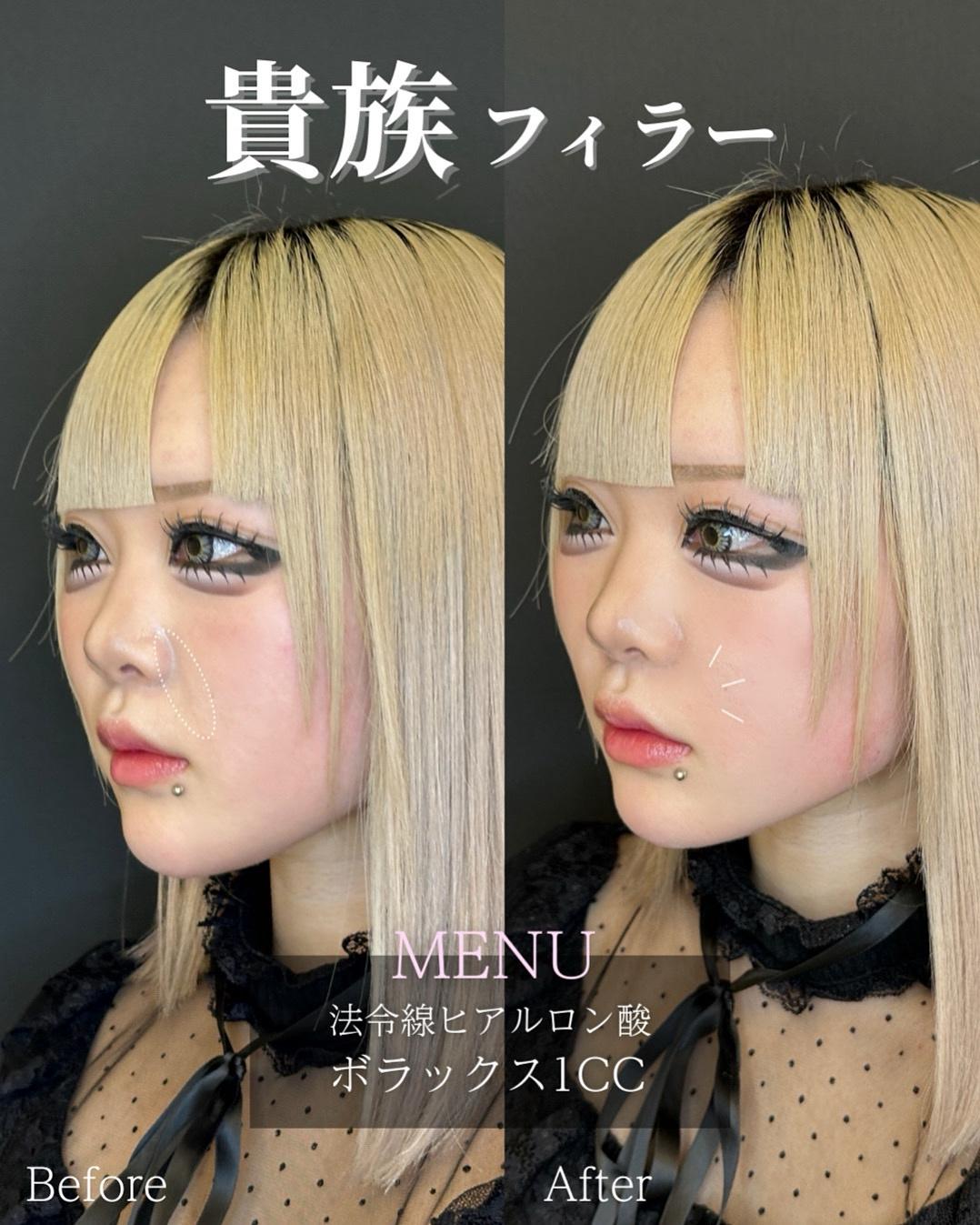 ヒアルロン酸の症例写真