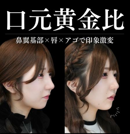 ヒアルロン酸の症例写真