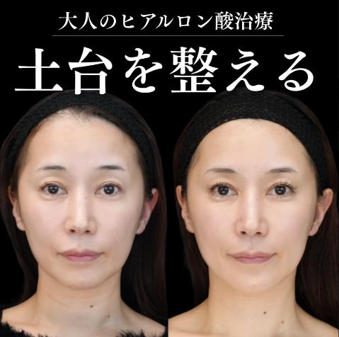 ヒアルロン酸の症例写真