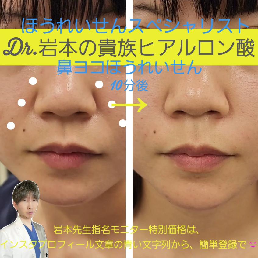 ヒアルロン酸の症例写真