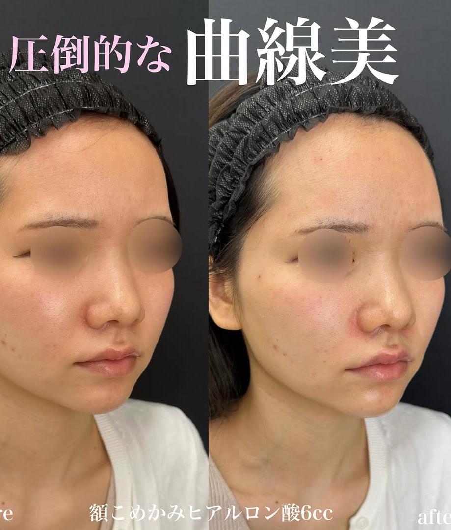 ヒアルロン酸の症例写真