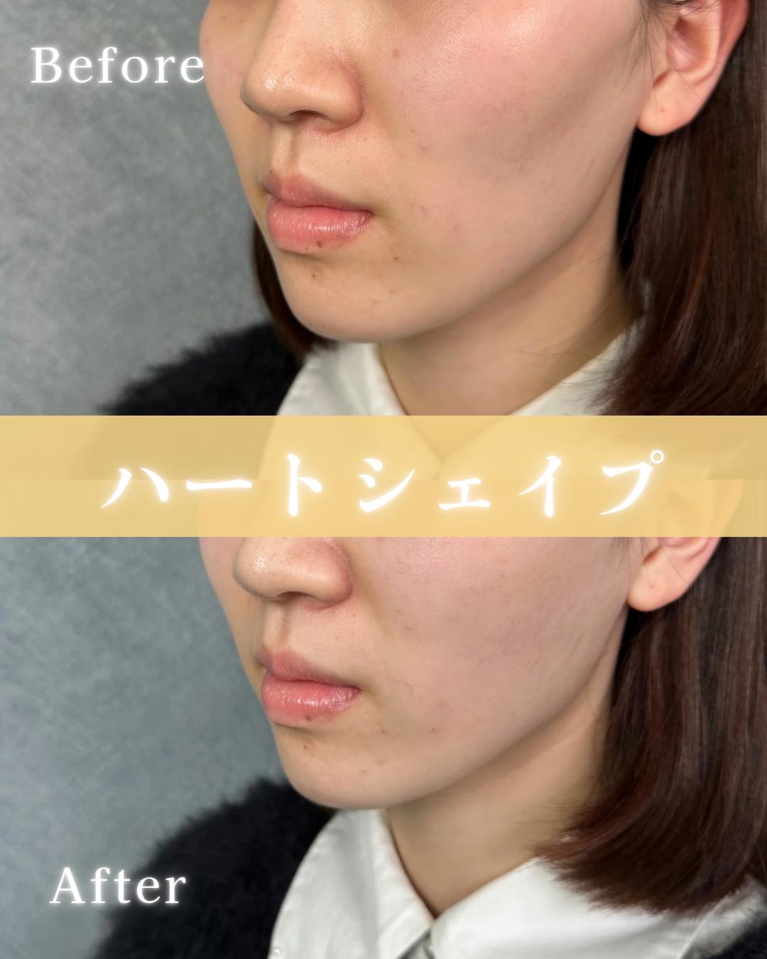 ヒアルロン酸の症例写真