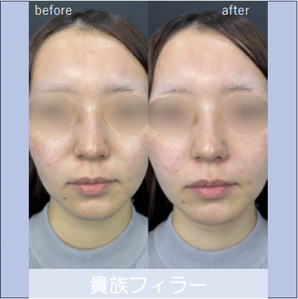 ヒアルロン酸の症例写真