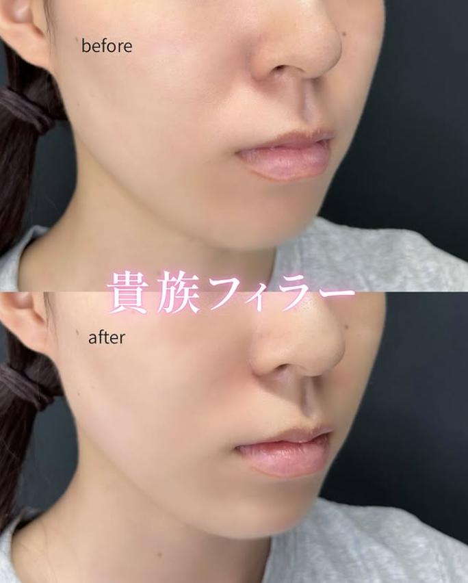 ヒアルロン酸の症例写真
