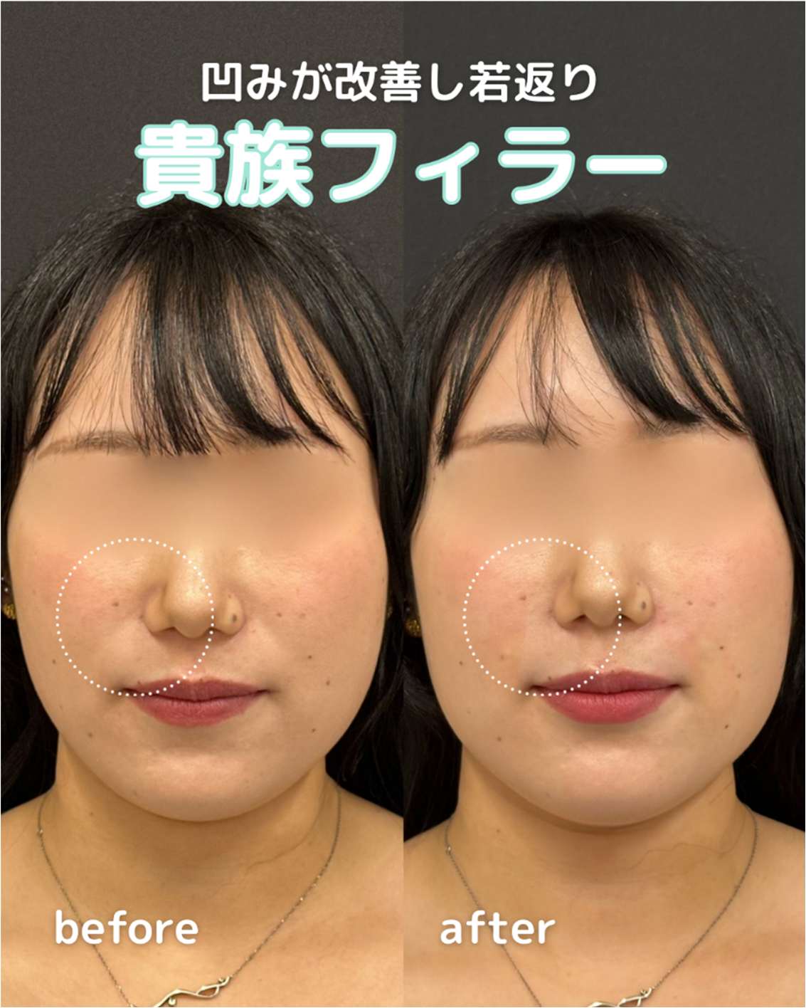 ヒアルロン酸の症例写真