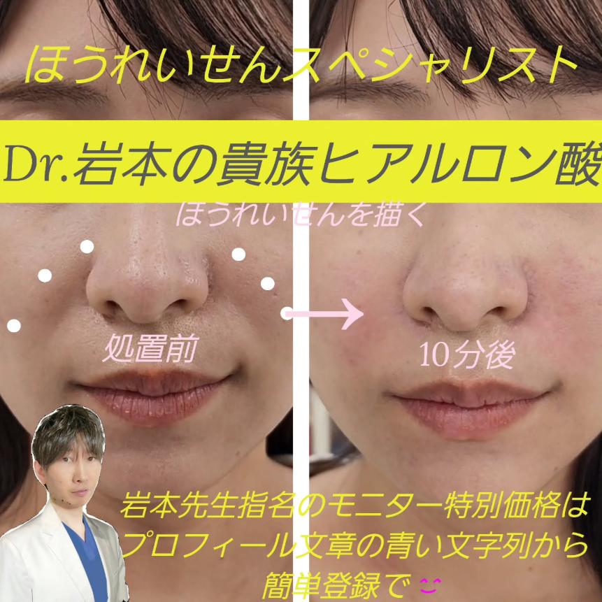 ヒアルロン酸の症例写真