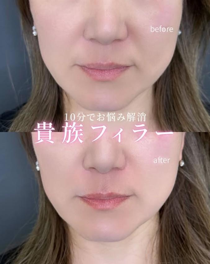 ヒアルロン酸の症例写真