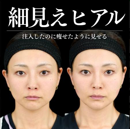 ヒアルロン酸の症例写真