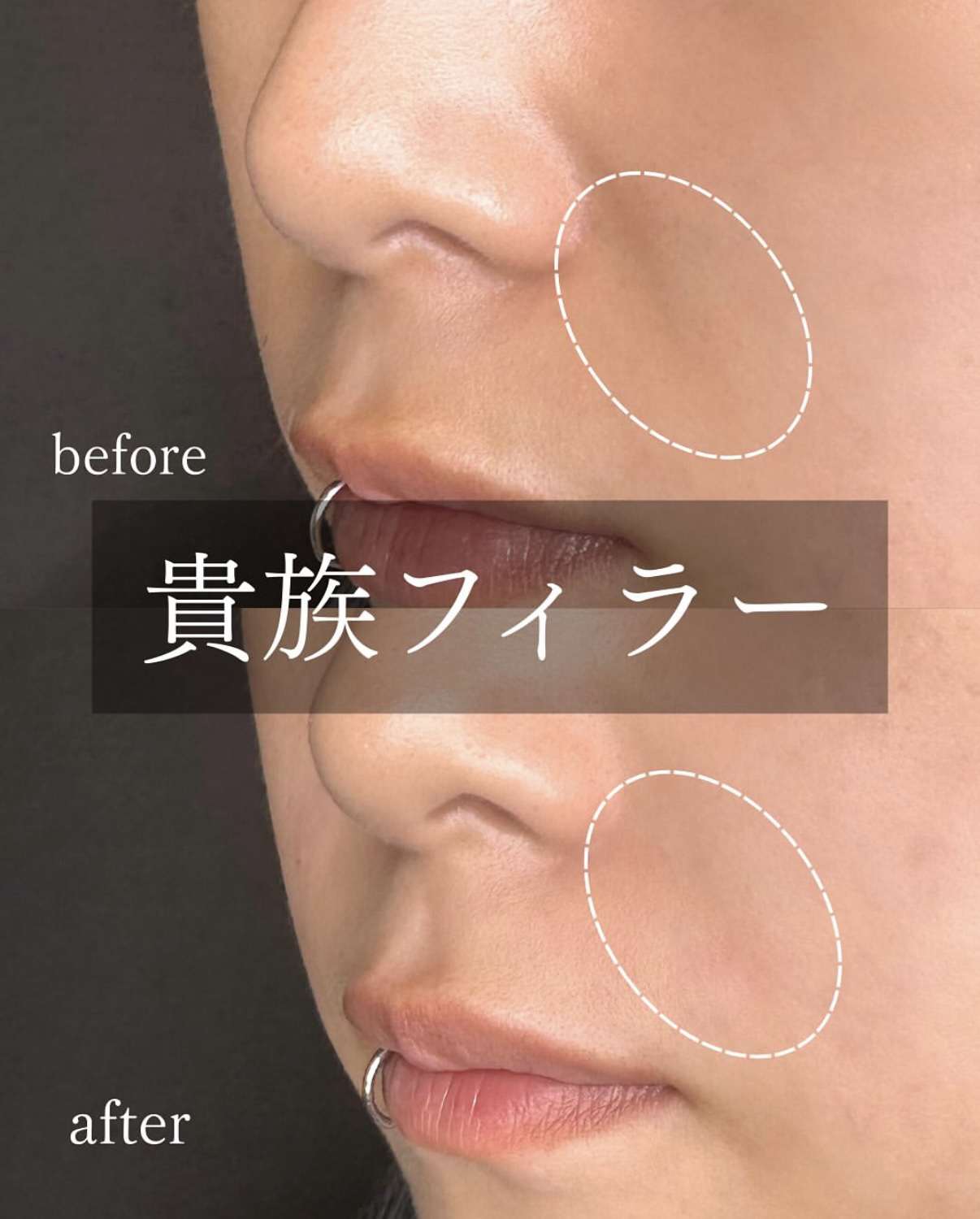 ヒアルロン酸の症例写真