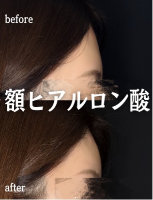 ヒアルロン酸の症例写真