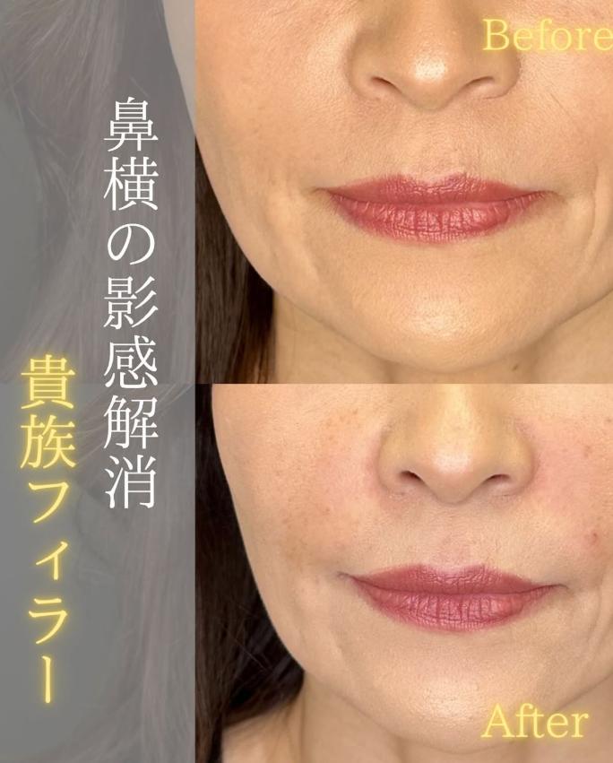 ヒアルロン酸の症例写真