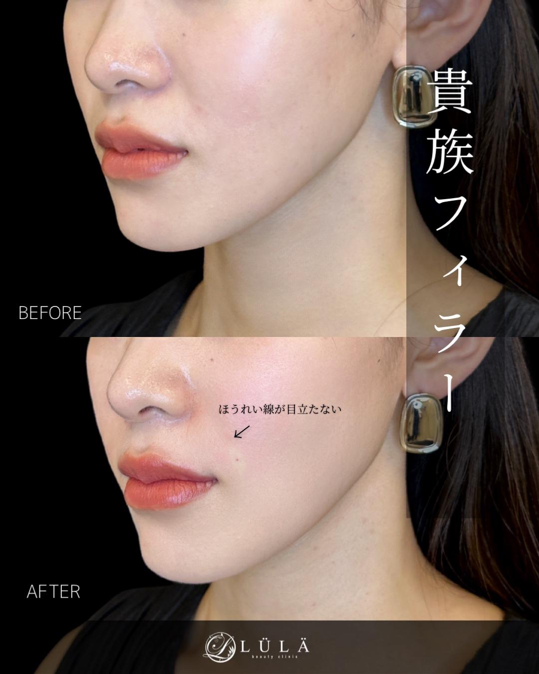 ヒアルロン酸の症例写真