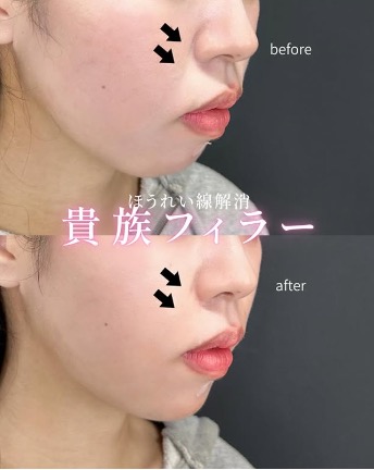 ヒアルロン酸の症例写真