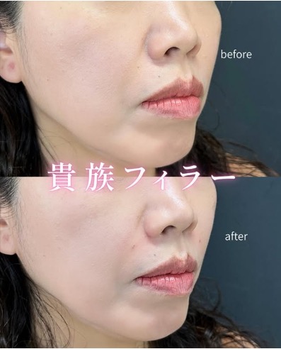 ヒアルロン酸の症例写真