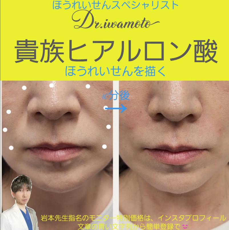 ヒアルロン酸の症例写真