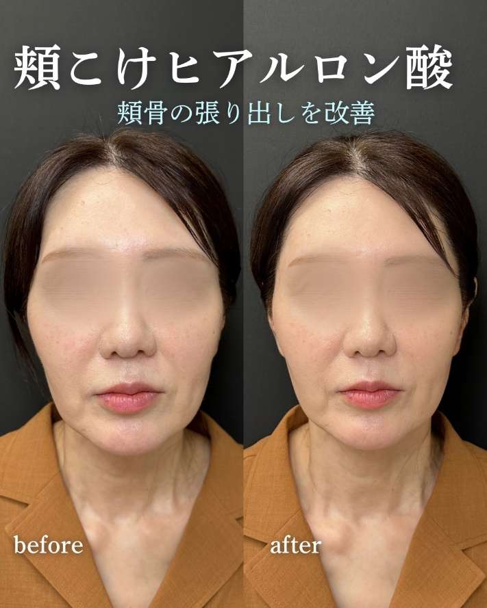 ヒアルロン酸の症例写真
