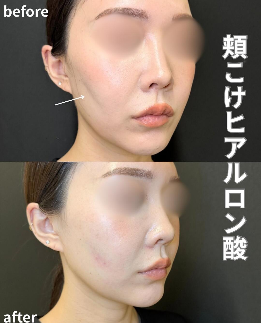 ヒアルロン酸の症例写真